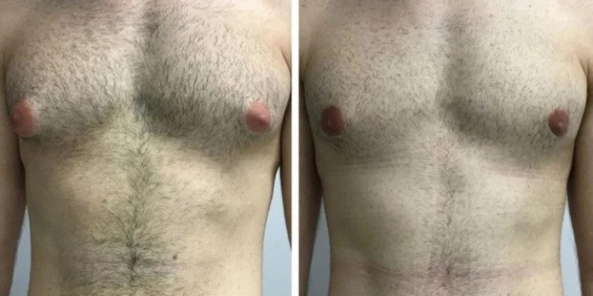 Exploring Male Chest Contouring for Gynecomastia in Dubai