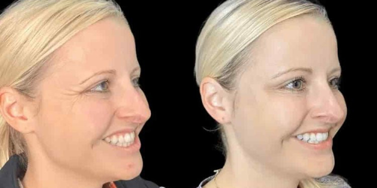 Best Doctors in Dubai for Botox: Factors That Influence Your Treatment Plan