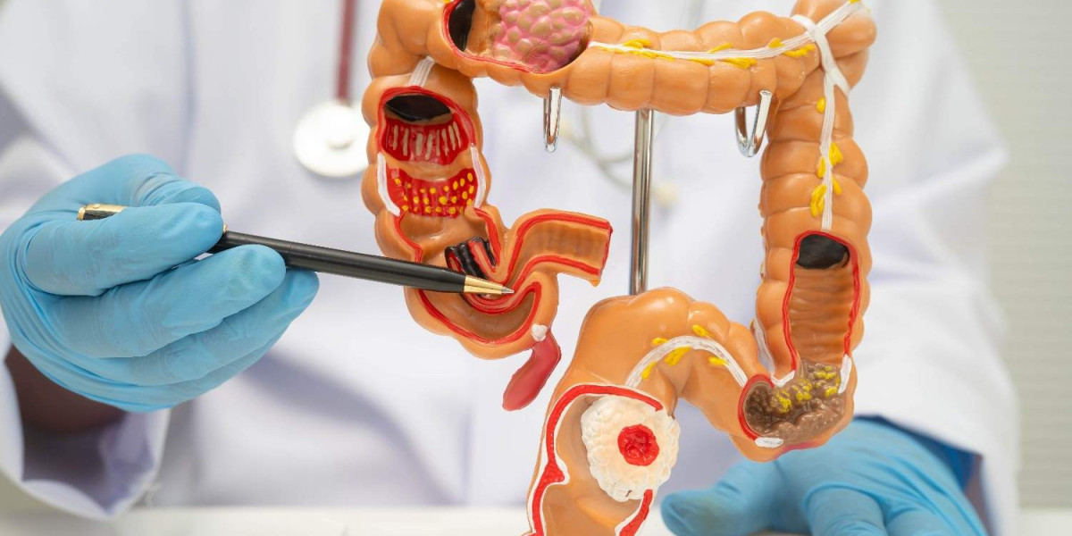 What Are the Early Signs of Colon Cancer?