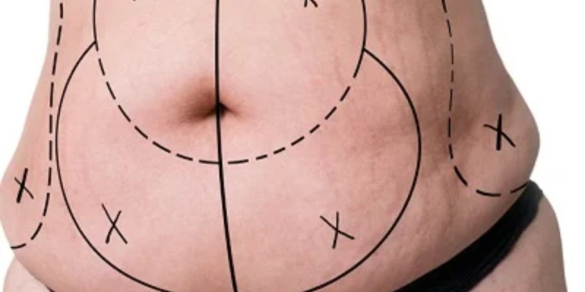 Could Abdominoplasty in Islamabad Improve the Look of a Relaxed Abdomen?