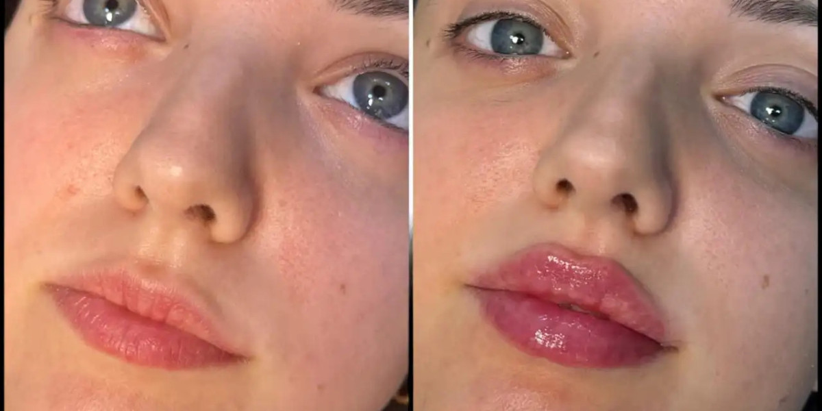 Best Fillers Clinic Experience With Best Doctors in Dubai