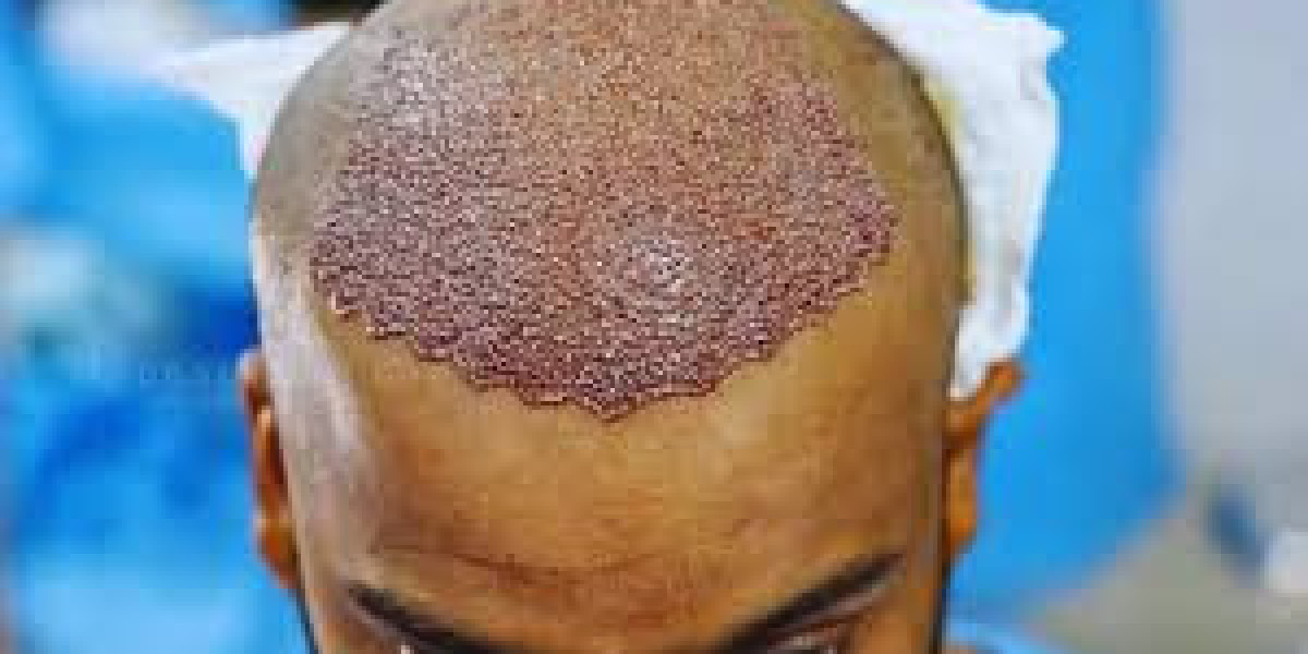 Hair Loss Treatment London: A Complete Guide to Hair Restoration Options