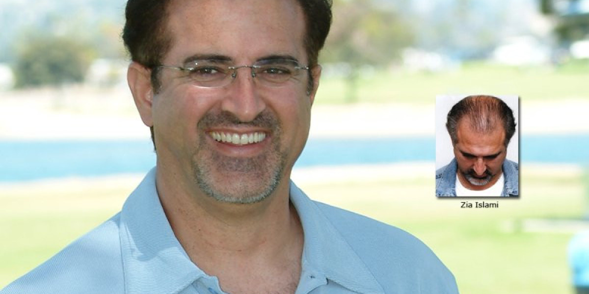 Hair Transplant Results Take Time: What Pakistani Patients Should Expect in the First 12 Months After Surgery