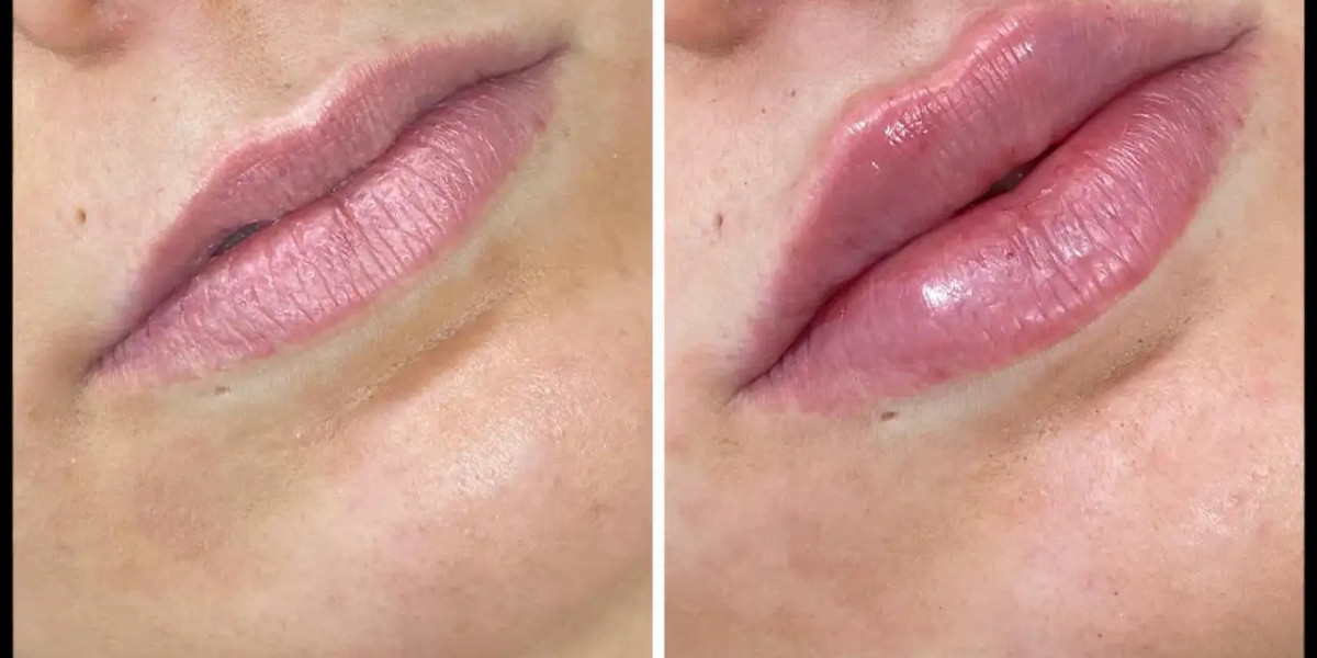 Dermal Fillers Treatment Guide by Best Doctors in dubai