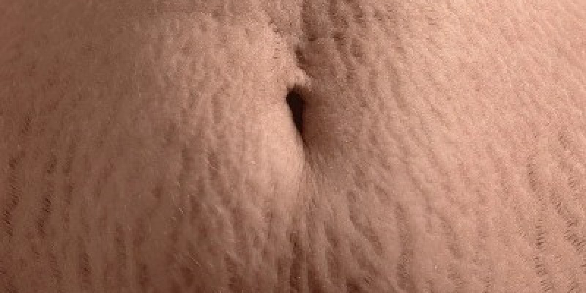 Is Stretch Mark Removal in Islamabad Suitable for Different Skin Types?
