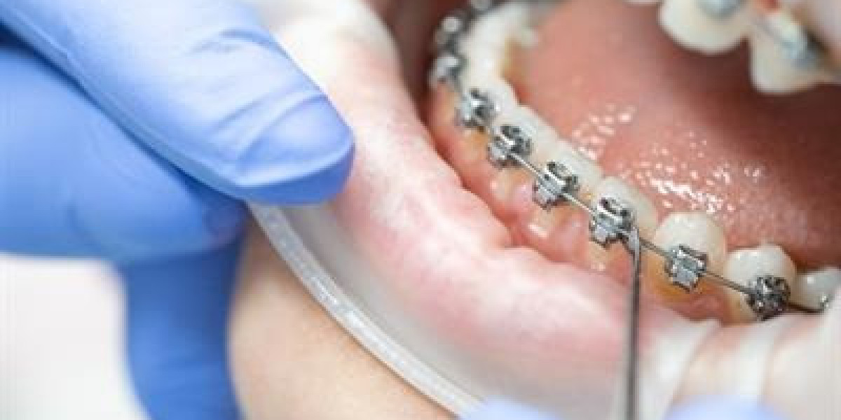 Can Dental Braces in Islamabad Improve a Uneven Bite?