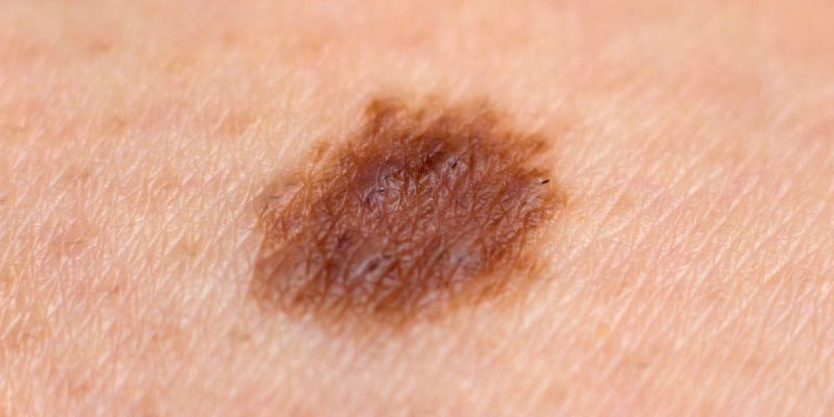 Skin Cancer Only: Why Specialist Skin Cancer Care Matters in Perth