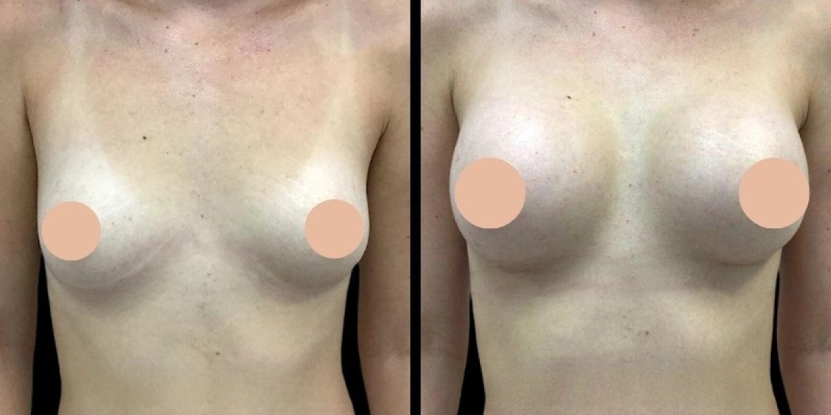 Breast Augmentation Surgery in Dubai: How Aging Can Change Breast Appearance